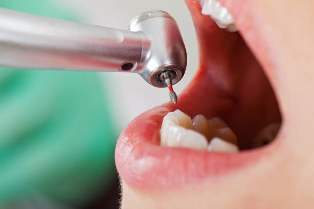 Best Emergency Wisdom Tooth Extraction in Dunlap, IL
